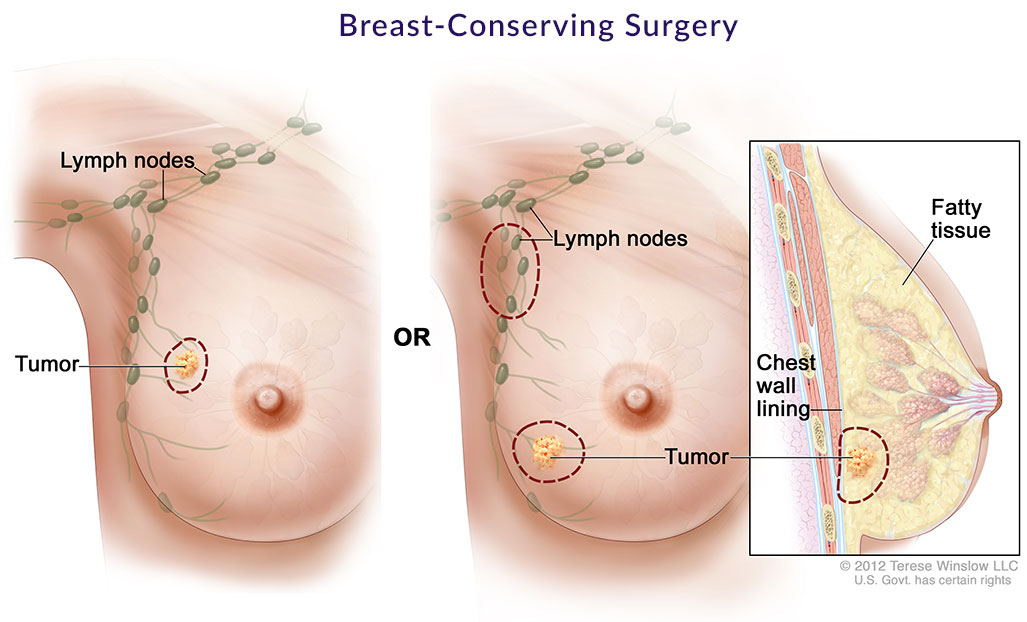 Breast Conserving Surgery illustration