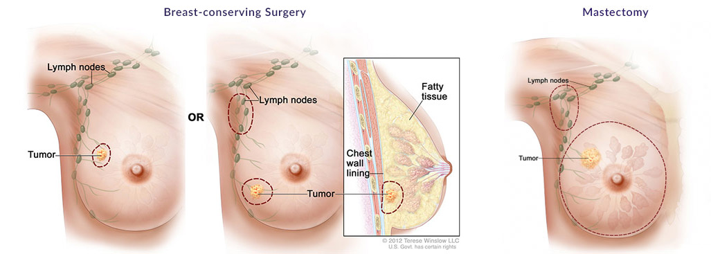 breast conserving and mastectomy surgeries illustration