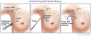 breast sentinel node biopsy illustration